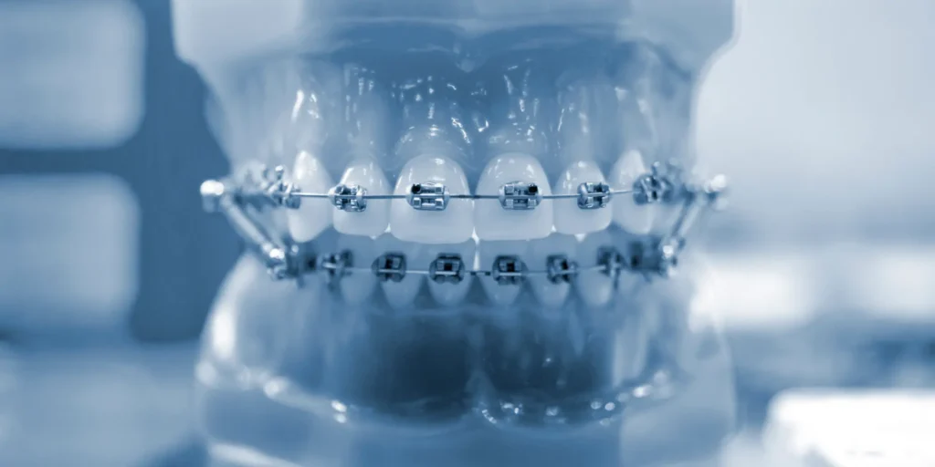 Tratamento das ortodontia