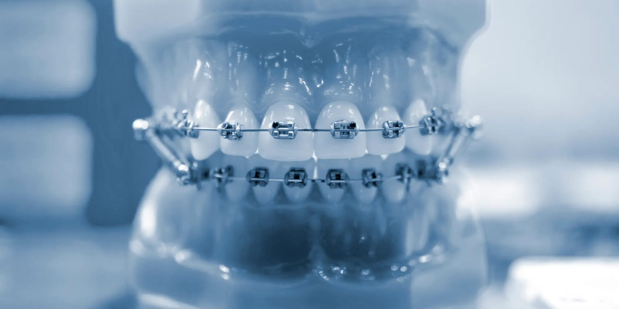 Tratamento das ortodontia
